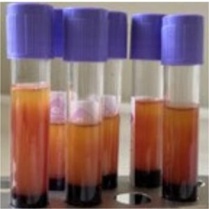 PRF treatment